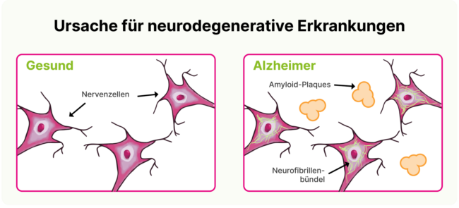 Neurodegenerative Erkrankungen: Beta-Amyloid-Plaque und Tangles im Gehirn